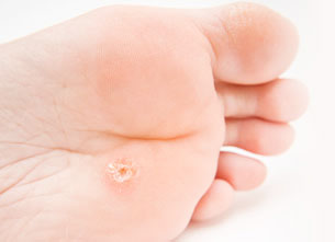 Plantar Siğillerden Nasıl Kurtulunur?