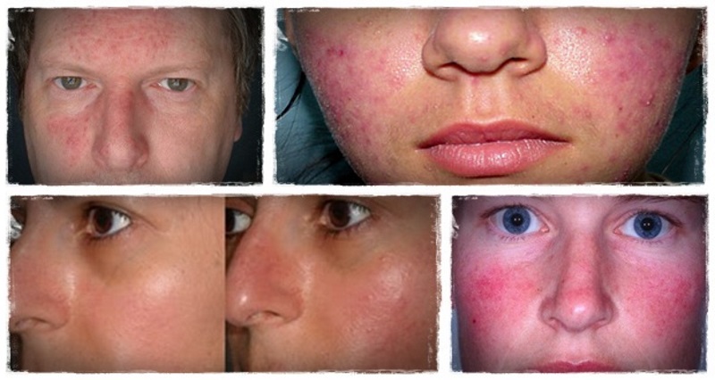 Rosacea için Bitkisel Tedavi Nasıl Uygulanır