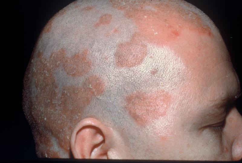 Seboreik Dermatit Nasıl Tedavi Edilir?