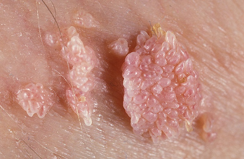 TCA Kullanarak HPV Siğili Nasıl Geçer?
